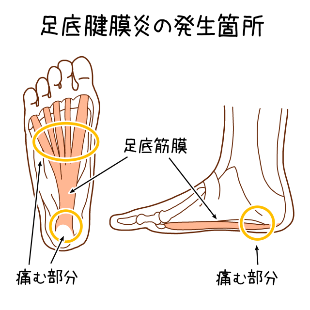 足底筋膜炎の痛みはこんな場所に出ます